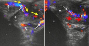 article-male-squirt-doppler-0-1200-628